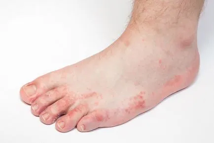 Az atópiás dermatitis a lábakon