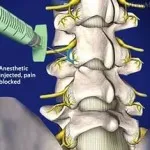 Osteoartrita a articulațiilor coloanei vertebrale dugootroschatyh