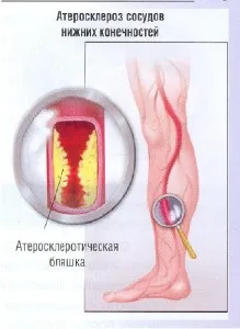 Ateroscleroza din partea inferioara a cauzelor extremităților, prevenire, diagnostic si simptome