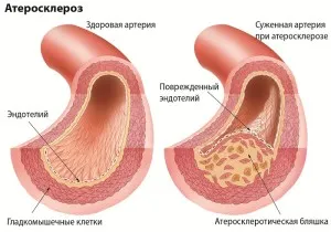 Atherosclerosis az alsó végtagok okok, megelőzésére, diagnosztizálására és tünetek