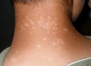 Бели петна по кожата - това е, след излагане на слънце лечение