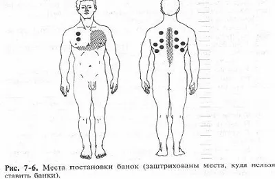 Банките с бронхит на гърба, ако можете да настроите и как да се