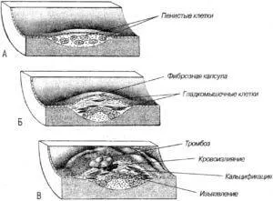 съдови плаки шийните прешлени