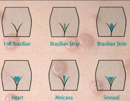 zona bikini îndepărtarea părului brazilian - cum