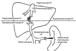 Цироза на черния дроб при хепатит със симптоми и лечението