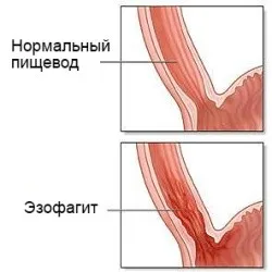 Tipuri de distale esofagită, cauze, simptome, tratament