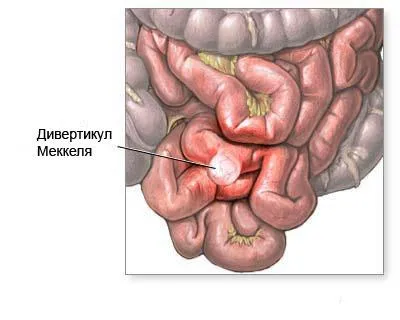 Simptomele diverticul Meckel și metode de tratament