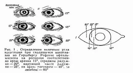 Диагноза ortoforii, orthotropy, Heterophoria, страбизъм