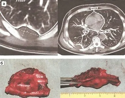 Diagnosticul tumorilor maligne primare ale peretelui toracic