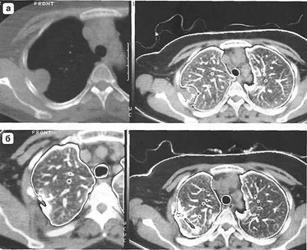 Diagnosticul tumorilor maligne primare ale peretelui toracic