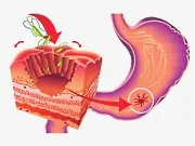 Terapia Eradicarea ulcer gastric și și cvadruple - o abordare integrată