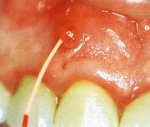 Endodontie - Clinica de Stomatologie Estetica - Maestro