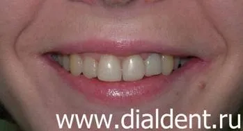 Естетично възстановяване на фронтални зъби с помощта на скобите инкогнито Lite