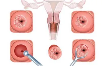 Eroziunea tipurilor de eroziune de col uterin și a soiurilor