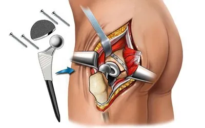 Hip artroplastie - esența operațiunii