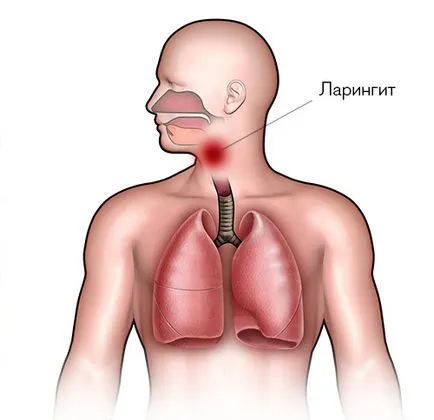 reflux laryngopharyngeal