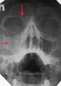 Sinusitis típusok, okok, tünetek, hatások a képen látható sinusitis, az összes sinusitis