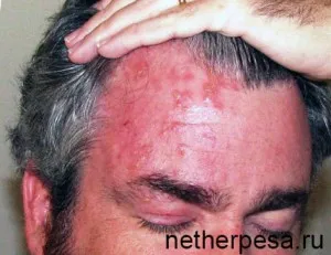 Herpes pe fața de cauze, tipuri, simptome, tratament, prevenirea