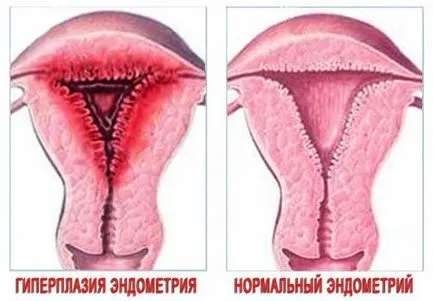 Хиперплазия и полипи, рак на ендометриума лек, подготвяне на терени ендометриоза