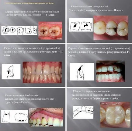 Simptomele profunde cariilor și tratamentul formelor acute și cronice