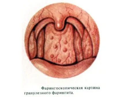 Гранулозните фарингит simpomy и лечение на остри и хронични при възрастни и деца