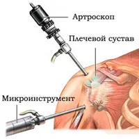 Sindromul impingement tratamentului articulației umărului