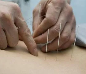 Acupunctura in tratamentul prostatitei