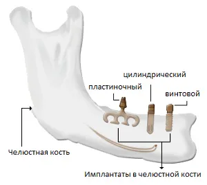 Имплантирането на Permi