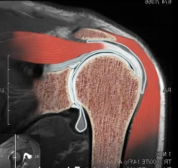 Sindromul impingement de sindromul articulației umărului drept