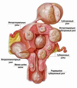 Interstițiale subseros fibrom uterin simptome, cauze, tratament