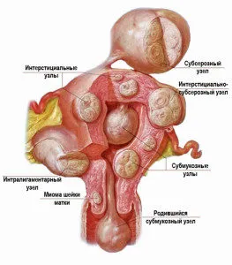 Междинните подсерозни миома на матката симптоми, причини, лечение