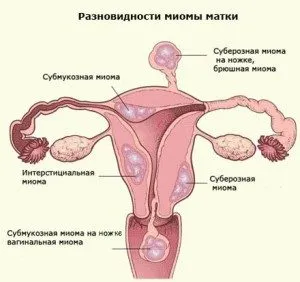 Междинните подсерозни миома на матката симптоми, причини, лечение