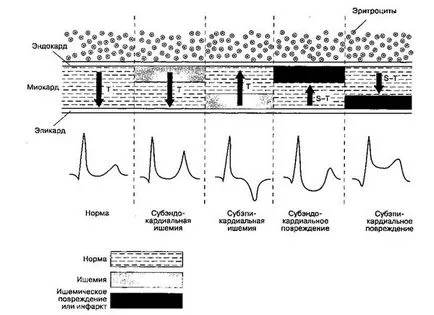 Efecte ischemie miocardică, ECG, tratament