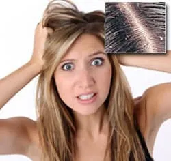 Cum de a obține rapid scăpa de mătreață și senzația de mâncărime scalpului - tratament de atac folk
