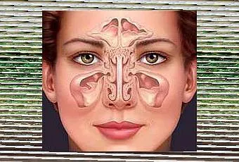 Hogyan kell kezelni arcüreggyulladás egyszerű tipp