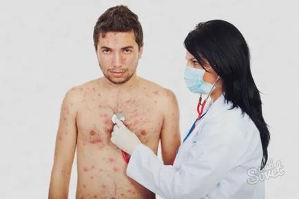 Cum de a trata varicela