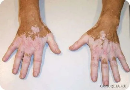 Hogyan lehet gyógyítani vitiligo az otthoni