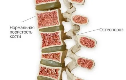 Diffúz osteoporosis okai, tünetei, diagnosztizálására, megelőzésére
