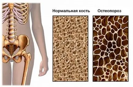 Diffúz osteoporosis okai, tünetei, diagnosztizálására, megelőzésére