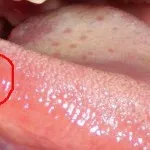 Cum este herpes pe buze - cum se produce infecția