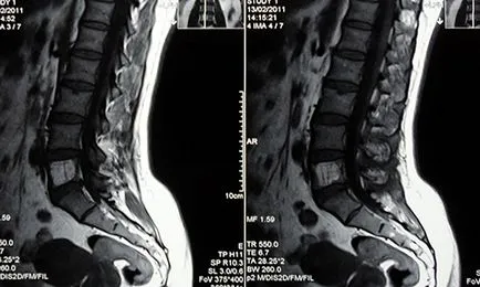 Какво е хемангиом гръбнака MRI на