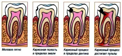 Кариес лечение на неусложнени и усложнени кариес - Стоматология Лана-дент