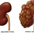 Cauzele chisturi renale si tratament