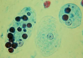 Intestinal amoebiază - simptome, tratament, diagnostic