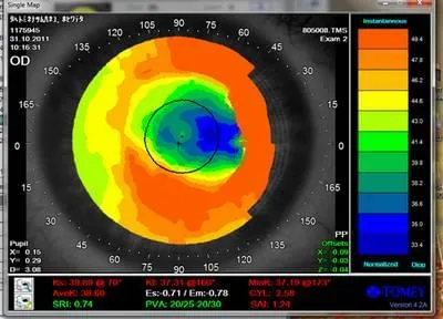 Топография на роговицата - метод на роговицата на очите изследвания