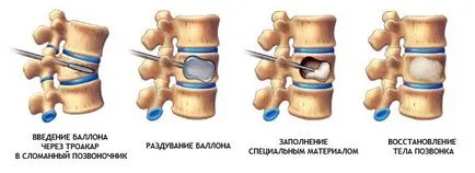 Kyphosis gyermekeknél - okoz, az osztályozás, a kezelés és a prognózis