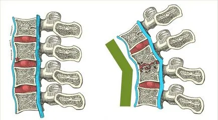 Kyphosis gyermekeknél - okoz, az osztályozás, a kezelés és a prognózis