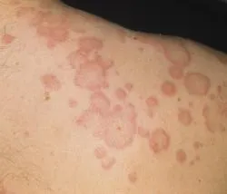 Urticaria vagy csalánkiütés