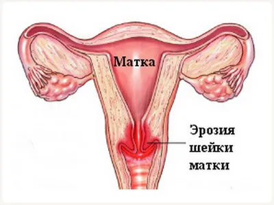 Criodistrucția cervix că acest lucru este în special procedura