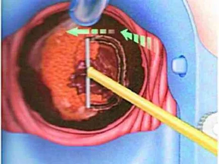 Criodistrucția cervix că acest lucru este în special procedura